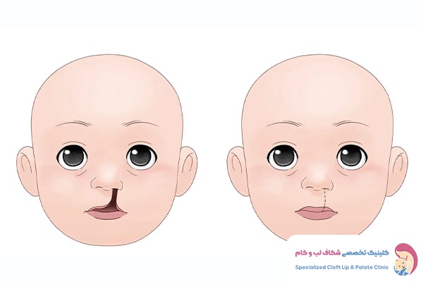 جراحی شکاف لب