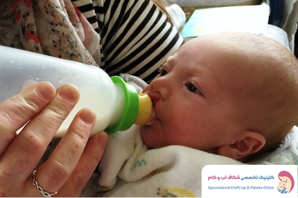 عوارض شیردهی نوزاد مبتلا به شکاف کام