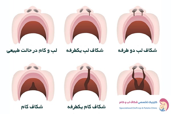 انواع درجات شکاف لب و کام
