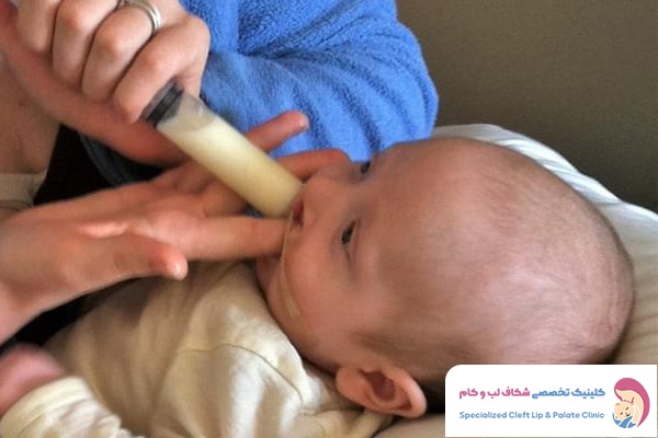 شیردهی نوزاد مبتلا به شکاف کام