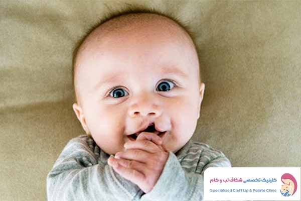 چالش های شیردهی به نوزاد مبتلا به شکاف
