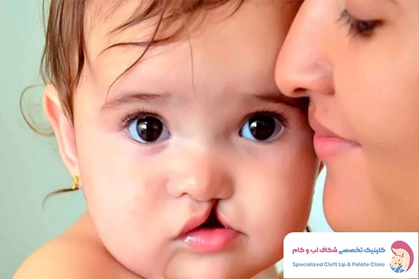 آرامش روانی مادر و نوزاد مبتلا به شکاف