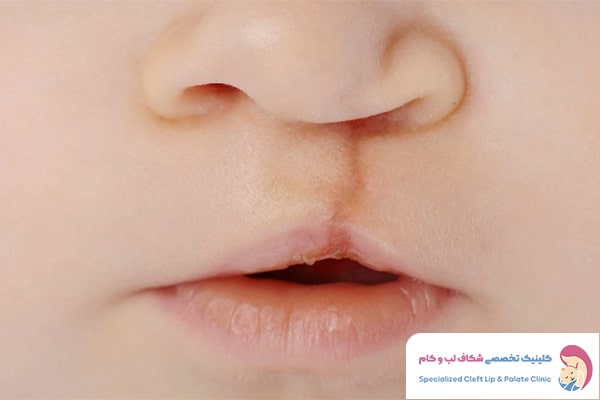 بهبودی پس از جراحی شکاف