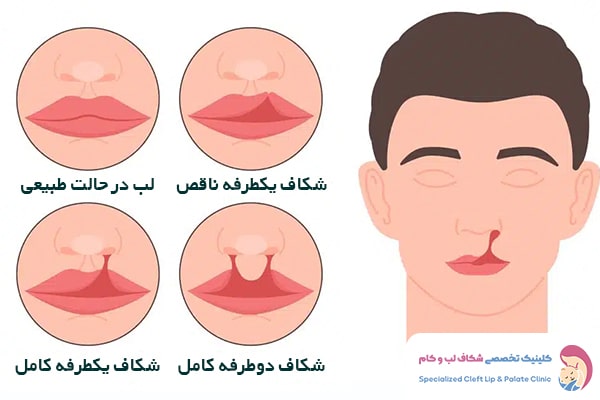 انواع شکاف لب