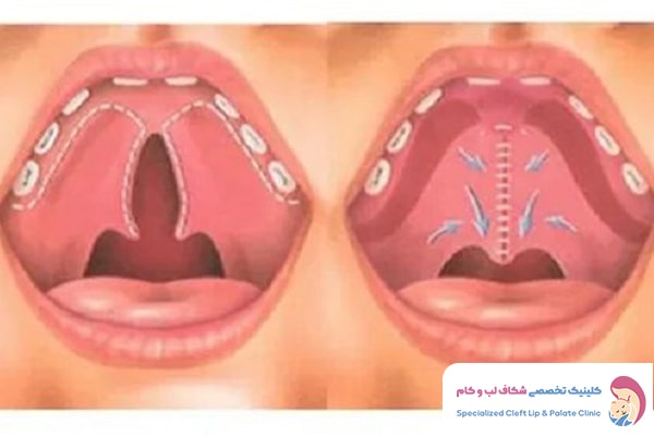 اهمیت و لزوم درمان شکاف کام و لب