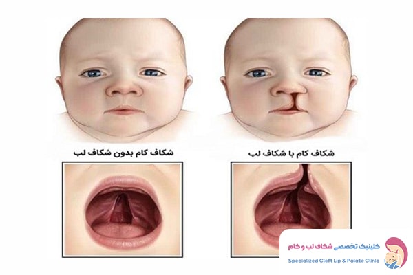 انواع شکاف کام