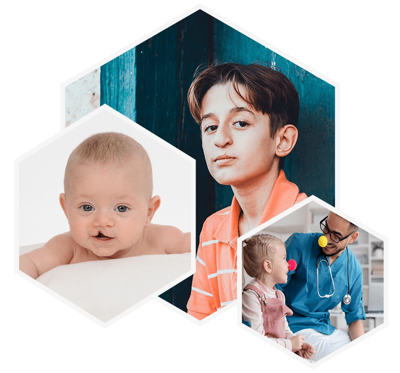 معرفی شکاف لب و کام